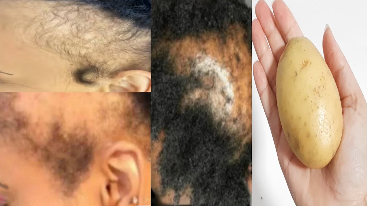 ELA TINHA BURACOS NA CABEÇA É TÃO FORTE QUE CRESCEU CABELO ATÉ NA TESTA ...