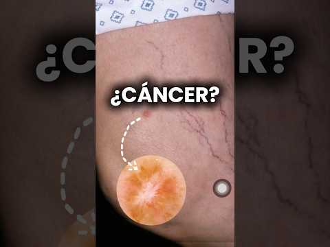 Revisa la piel de tus piernas, podrías tener este tumor (Dermatofibroma). #dermatologia #dermatologo