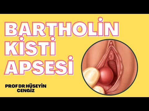 Video: Bartholin Kistinden Nasıl Kurtulur: 12 Adım (Resimlerle)