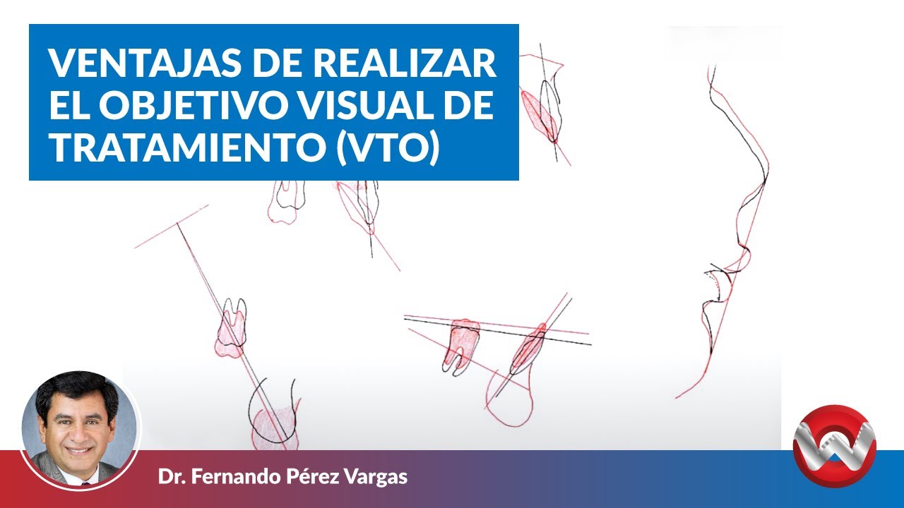 Ventajas de Realizar el Objetivo Visual de Tratamiento (VTO) YouTube