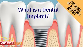 Now Trending - Dental Implants by Dr. Ramsin Davoud