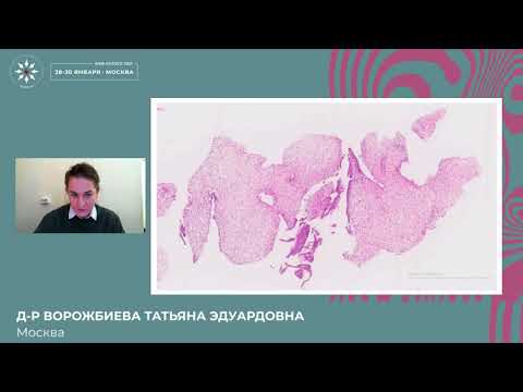 Дифференциальная диагностика фиброэпителиальных опухолей молочной железы и метапластического РМЖ