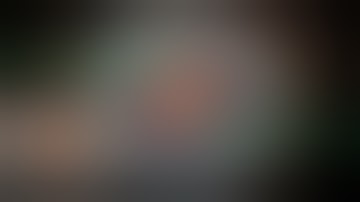 Cionni Ring Implantation for Subluxated Cataract