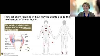 "(Mucosal) Barriers for Understanding Axial Spondyloarthritis" by Kristi Kuhn, MD, PhD