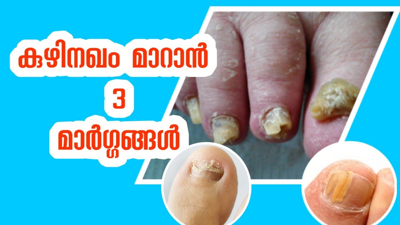 കുഴിനഖം മാറാൻ 3 ടിപ്സ് part 2 toenail fungus kuzhi nagam