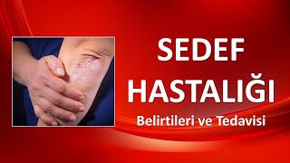 PSORIASIS Symptoms and Treatment