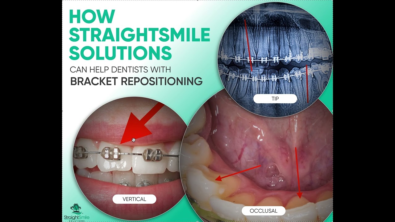 Bracket Repositioning Support with StraightSmile Solutions
