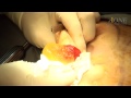 가슴확대 재수술 (Revision Augmentation Mammoplasty)