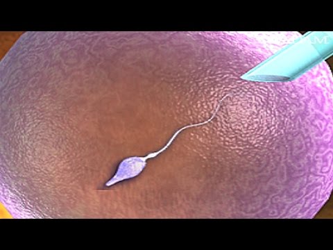 how-does-intracytoplasmic-sperm-injection-work?-icsi-ivf-procedure-for-pregnancy-animation-video