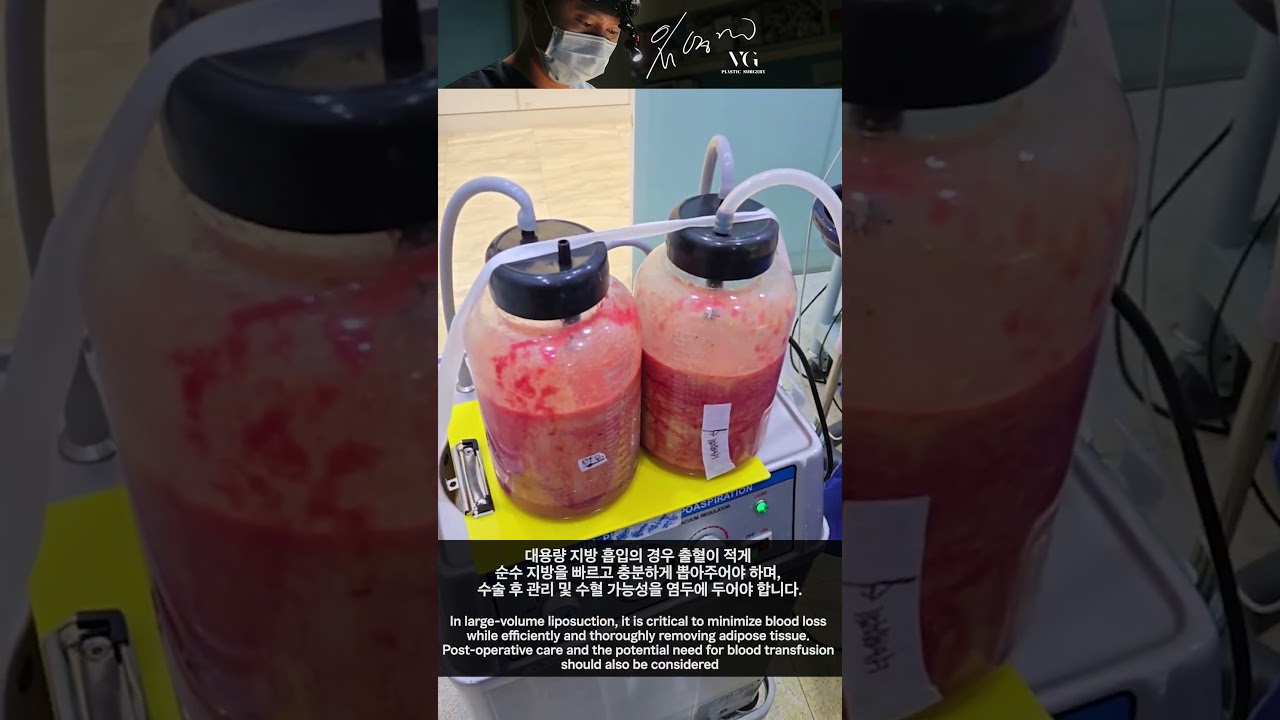 [貝麗好整形外科診所] 抽脂的教科書 #抽脂 #抽脂手術 #瘦大腿 #抽脂