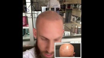 Dallas Scalp Micropigmentation (SMP) Testimonial