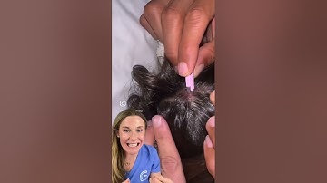 Dermatologist reacts to botfly extraction. Original video credit: the bucket list family. #botfly