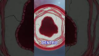 Destruyo El Calcio De Las Arterias Con Ondas De Choque