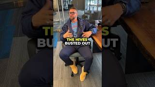 Do You Get Hives When It Gets Cold Or Hot?