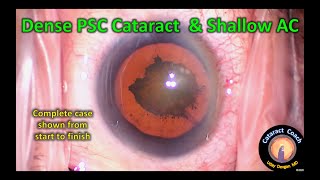 Complete Cataract Surgery: dense PSC and shallow AC