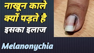 हाथ के नाखून काले क्यों पड़ते है ? || Melanonychia in Hindi || MedHealth Support