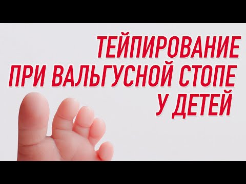 ✅ ТЕЙПИРОВАНИЕ ПРИ ВАЛЬГУСНОЙ СТОПЕ У ДЕТЕЙ  Наталья Суворова  Учебный центр BBALANCE