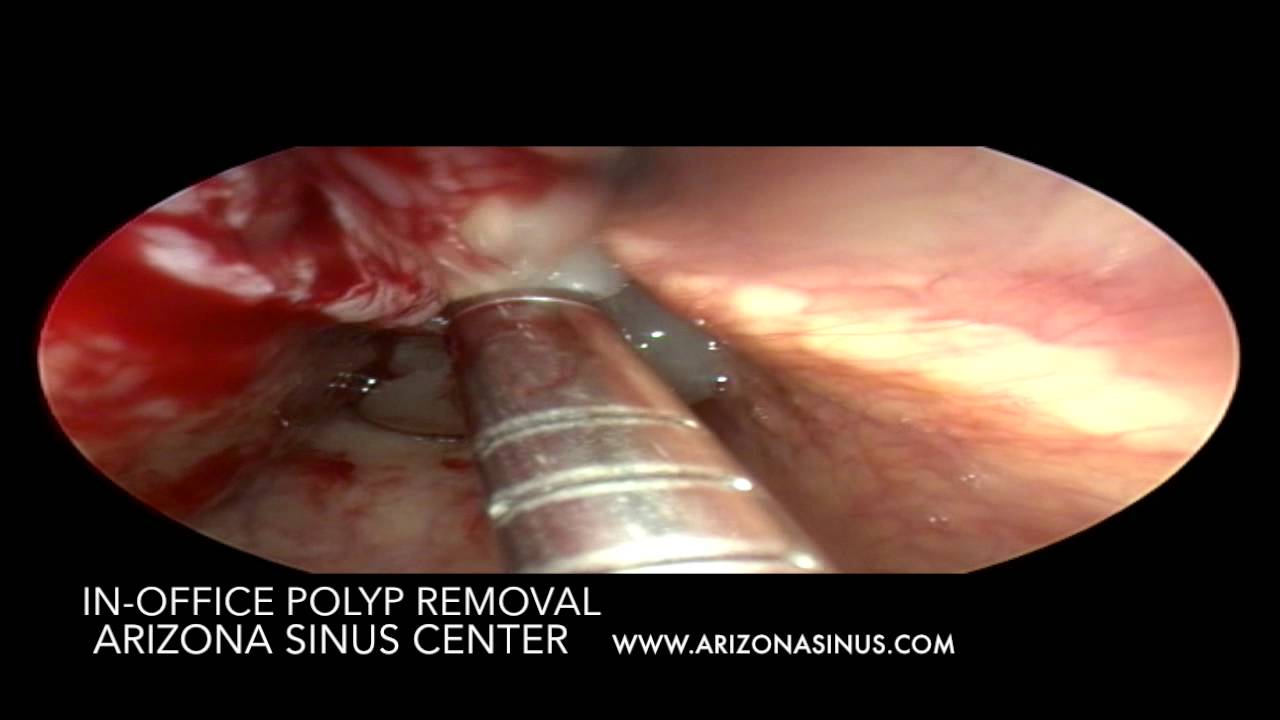 Polypvac In Office Removal Of Nasal Polyp Removal Arizona Sinus Center Phoenix