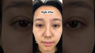 #irvinecalifornia #sbc #asianeyelids #beforeandafter #botox