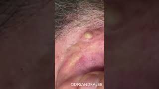 VERY nice and easy... ✌️❤️💥 #drpimplepopper #popaholics @DrPimplePopper