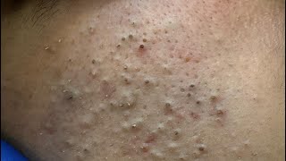 Deep Pore Cleansing | Blackheads and Pimples Removal