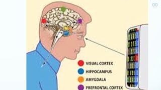 Consequences of a TBI Causing Dysfunction in Visual Processing: Treating PTVS & VMSS