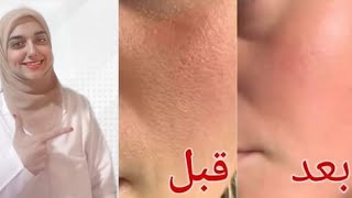 الحل النهائى للتخلص من المسام الواسعة في ٣ أيام فقط..