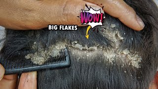 Scratching Dandruff Off Scalp Big Flakes #1039