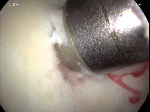 Articular Cartilage Paste Grafting Surgical Technique performed by Kevin R. Stone, MD