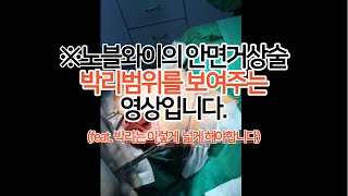 노블와이성형외과 김창연원장의 안면거상술 박리범위를 보여주는 실제 수술 영상 입니다. (★더보기란 필독★)
