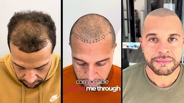 From covering Hairloss with Hair Fibers to Scalp Micro Pigmentation as a long lasting Solution! ✅
