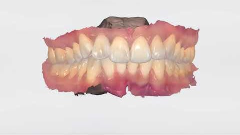 3Shape 트리오스 - 검사 및 분할 편집 – 3Shape TRIOS Patient Monitoring