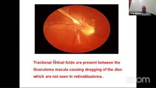 RETINOBLASTOMA Dr Tareik Aldoais Dr Yaqoub Yousf  Dr Mustafa Muhyar