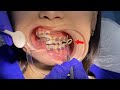 Traditional metal braces. How An Orthodontist Corrects Your Teeth