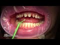 porcelain dental crowns and porcelain dental veneers before and after