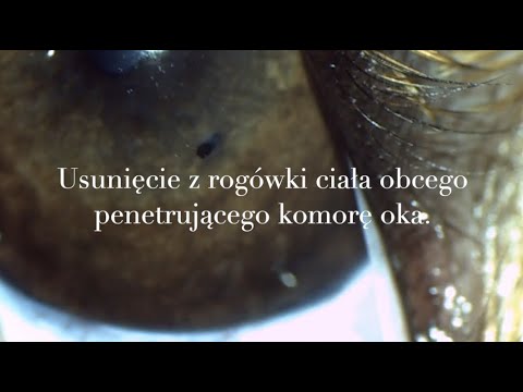 Wideo: Jak wyleczyć wodniaka: 9 kroków (ze zdjęciami)