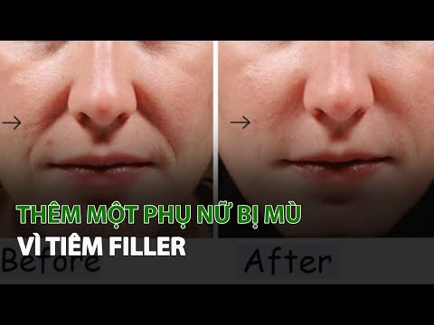 Video Thêm một Phụ Nữ bị mù vì tiêm Filler| VTC14 - youtube