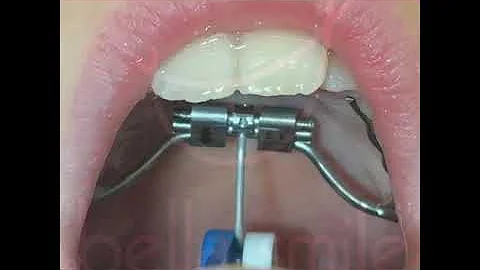 How to turn an expander