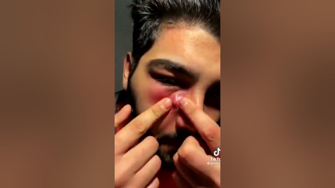 Cystic acne popping 2022 loan nguyen newest cyst popping videos YouTube