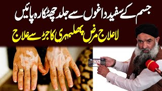 Phulbehri Ka Ilaj In Urdu/Hindi | Vitiligo Treatment | White Spot On Skin | Dr Sharafat Ali