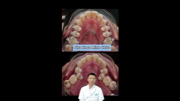 Tình Trạng Răng Lệch Lạc Và Hẹp Hàm | Bác Sĩ Yên