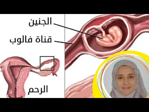 فيديو: كيفية التعرف على الحمل خارج الرحم