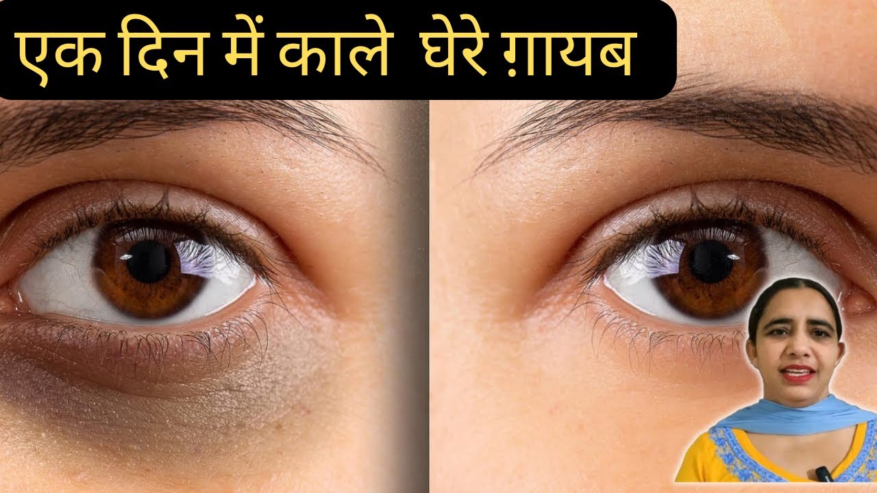 dark-circle-kaise-hataye-natural-home-remedies-for-removing-dark