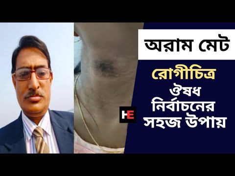 Aurum Met - রোগীচিত্রঃ অরামমেট । Thyroglossal Fistula | Dr. Rabin Barman | Homeo Express