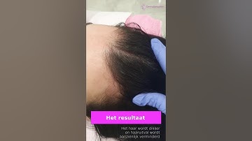 Last van haaruitval, word je kaal of heb je heel dun haar?