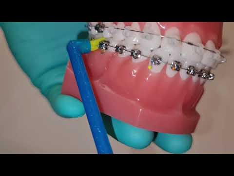 Videó: A fogak tisztítása fogszabályzóval: 12 lépés (képekkel)