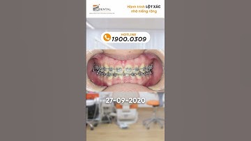 Hành trình LỘT XÁC nhờ niềng răng của Thanh Châu