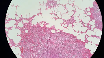 O que causa pneumonia granulomatosa?