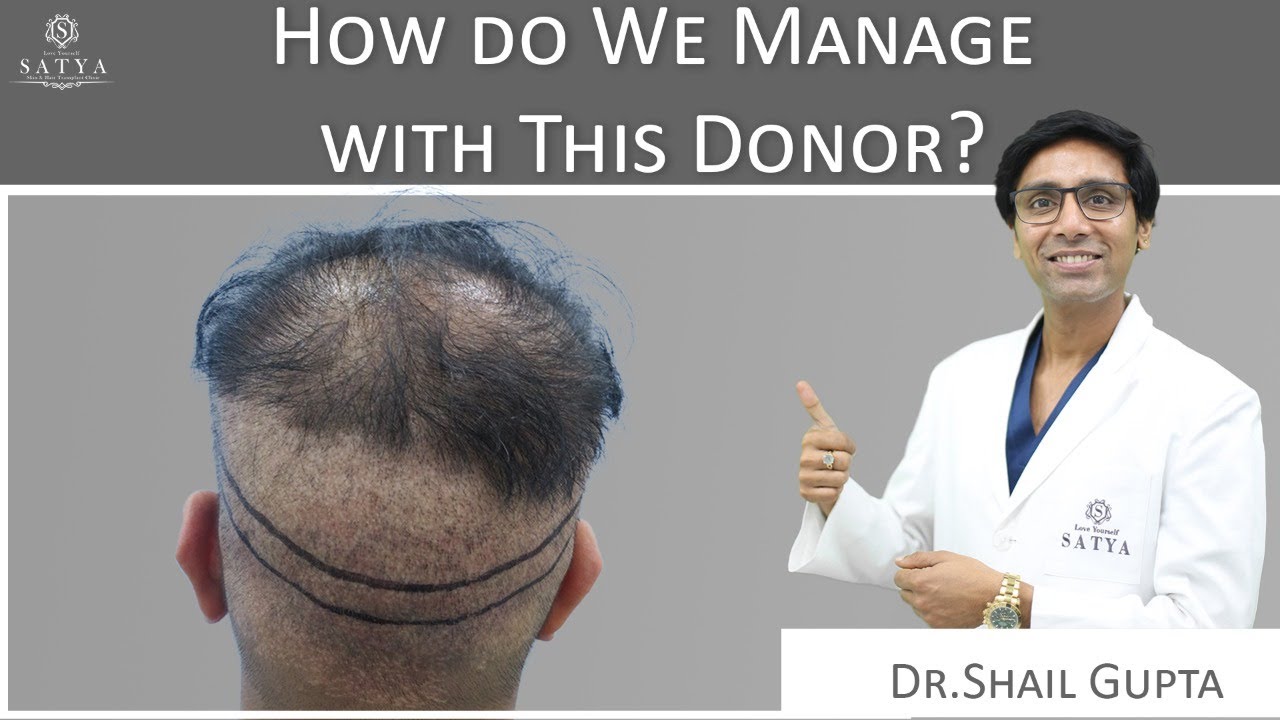Corrective Hair Transplant Satya | Redo Hair Transplant | Repair Hair Transplant Clinic | Dr Shaiil