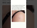 a circular, indented scar on a person's upper arm or shoulder area